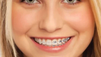 Tipos de Brackets en Ortodoncia