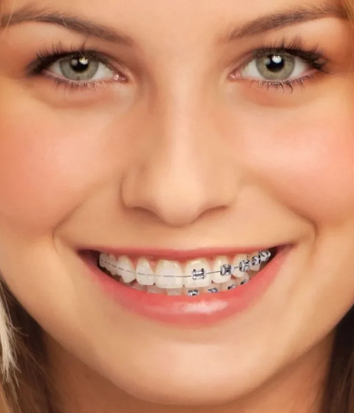 Tipos de Brackets en Ortodoncia