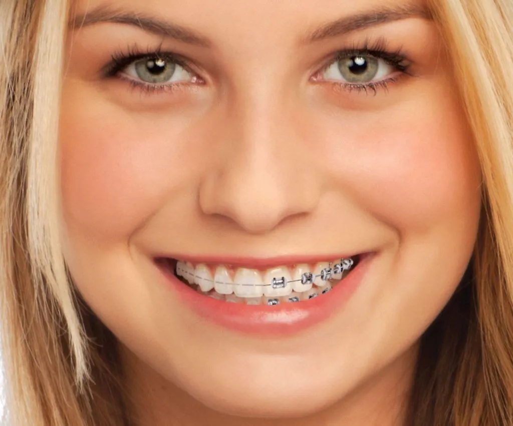 Tipos de Brackets en Ortodoncia