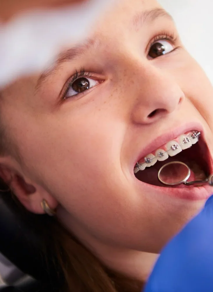cuándo poner ortodoncia (brackets) en niños
