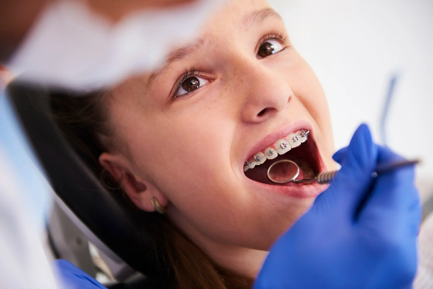 cuándo poner ortodoncia (brackets) en niños