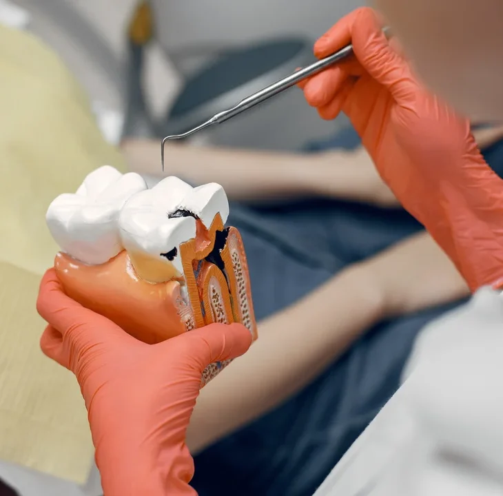 Precio del tratamiento de conducto o endodoncia en Venezuela